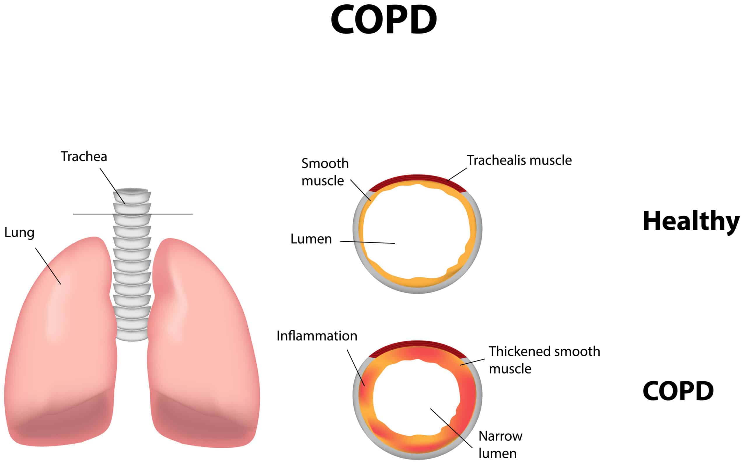 COPD