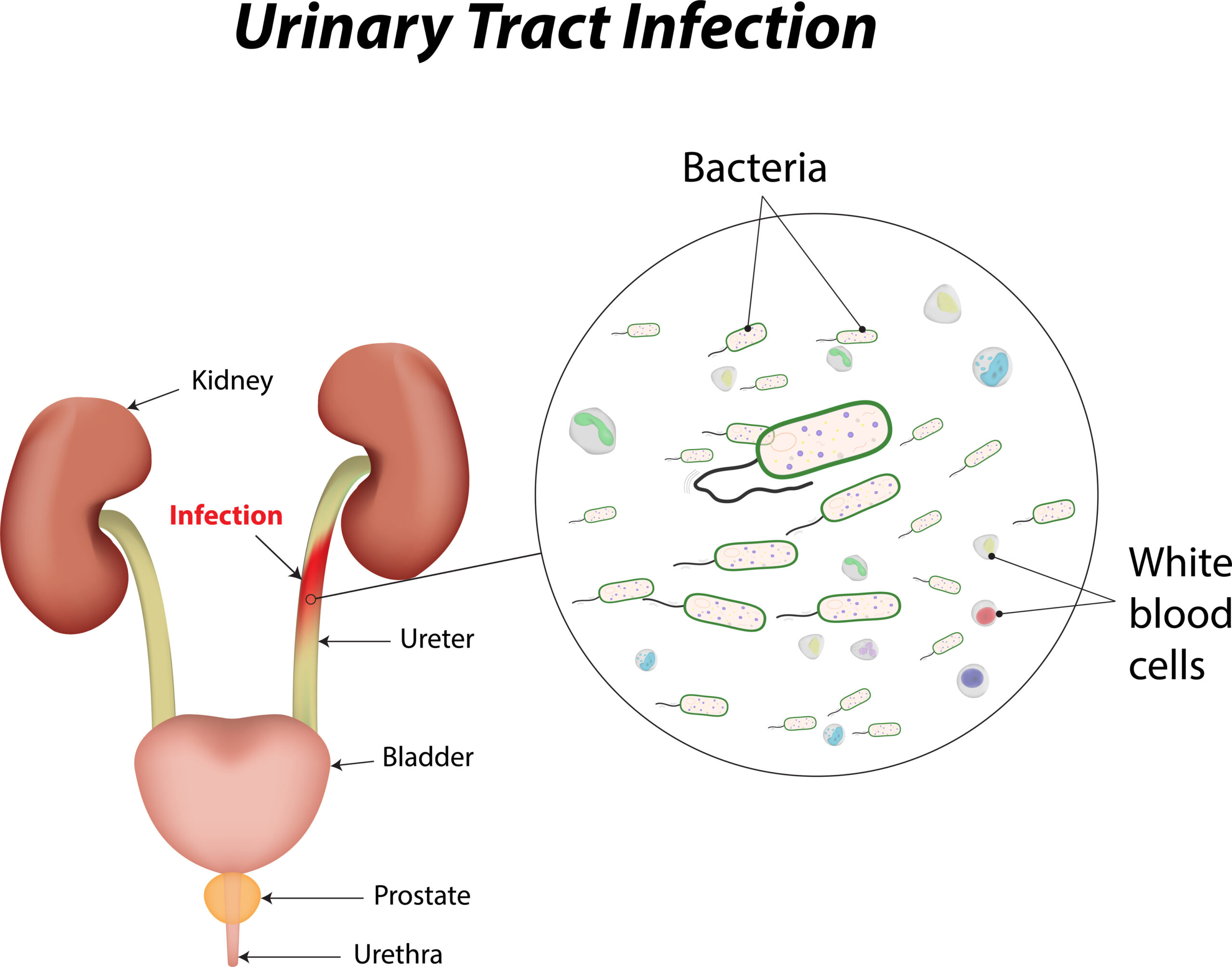 uti, urinary tract infection, bladder infection