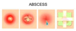Abscess Treatment High Point | Abscess Drainage Lexington