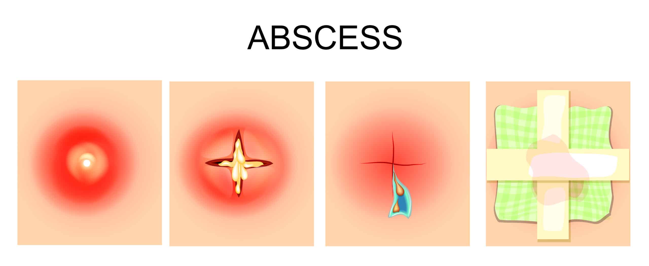 abscess