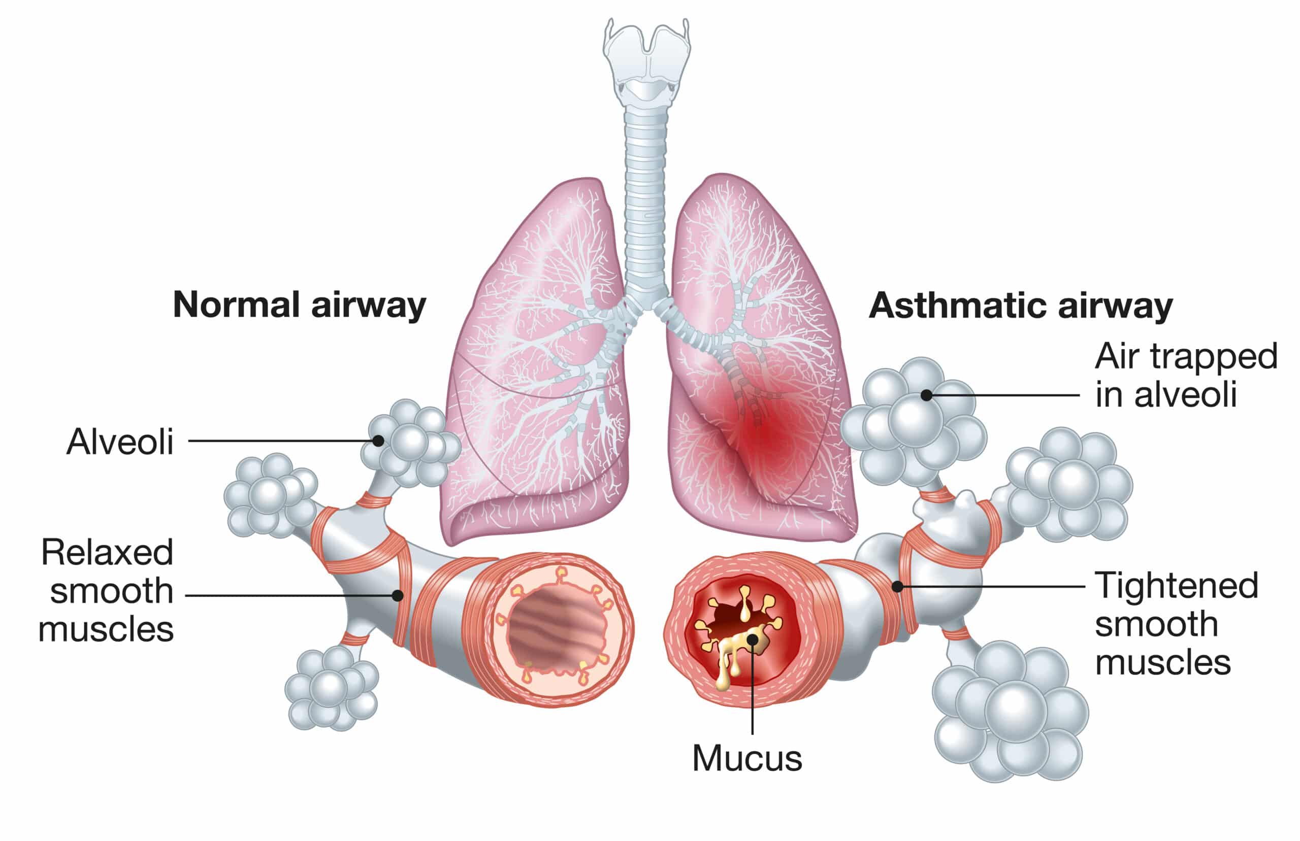 Asthma diagram