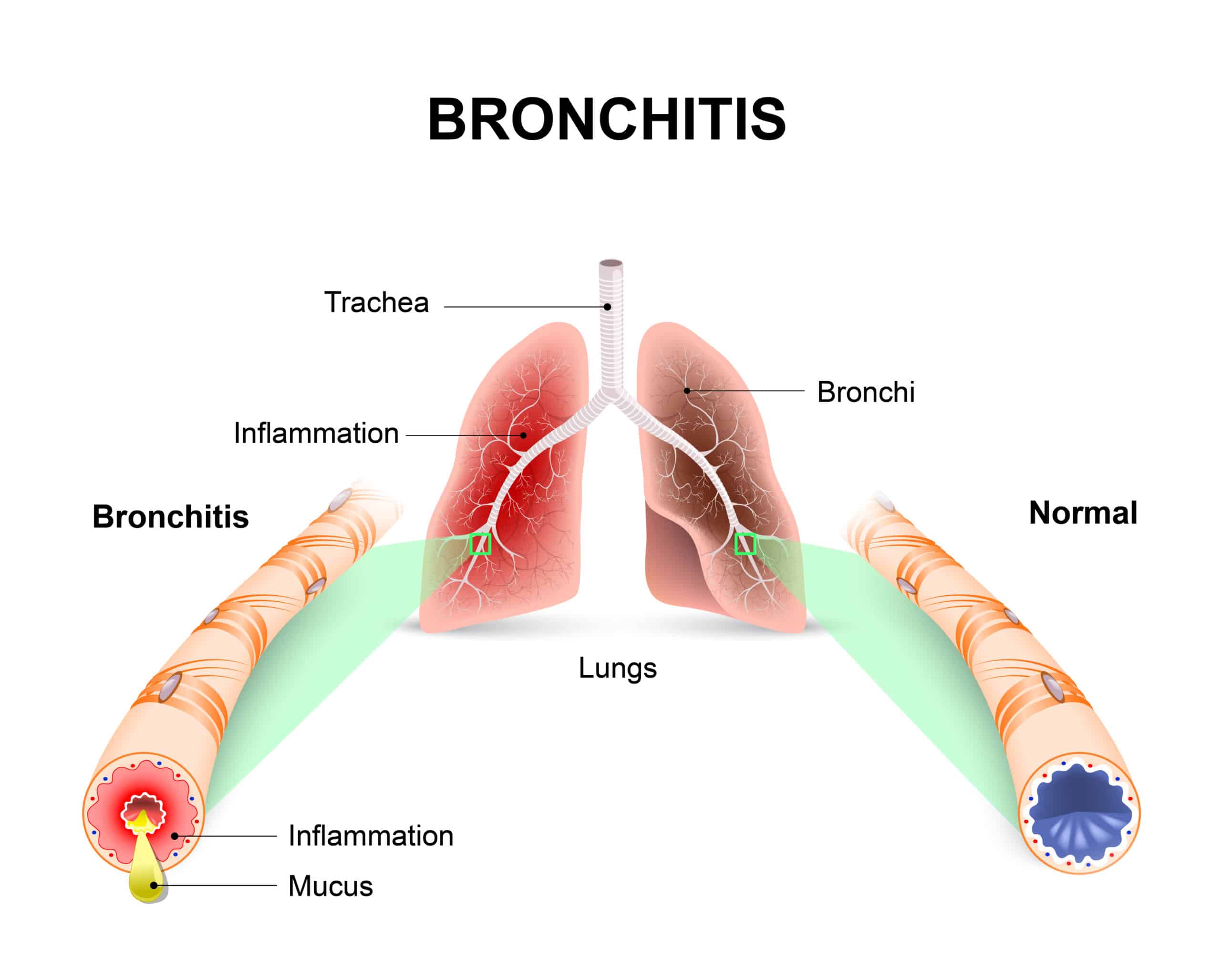 acute bronchitis