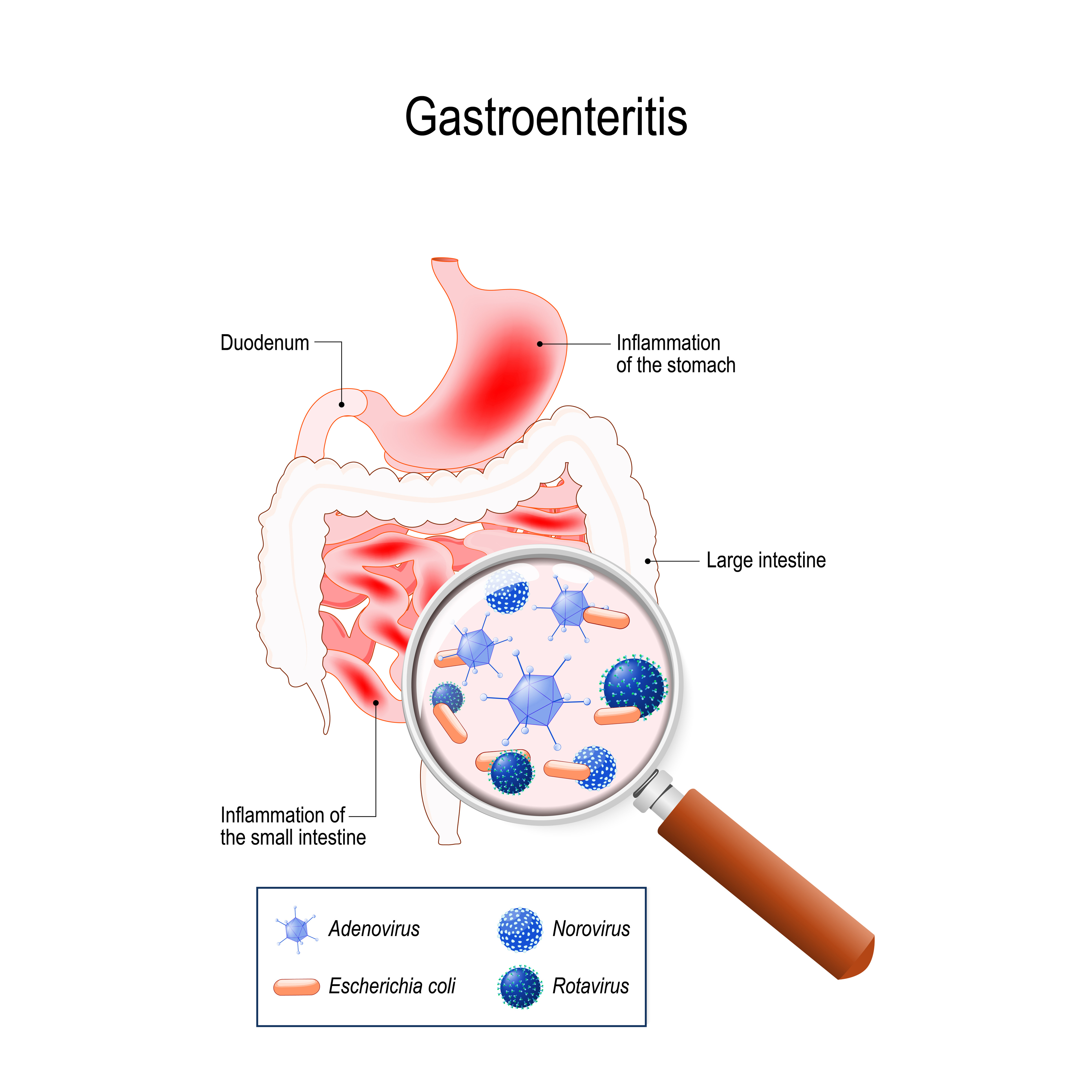 gastroenteritis