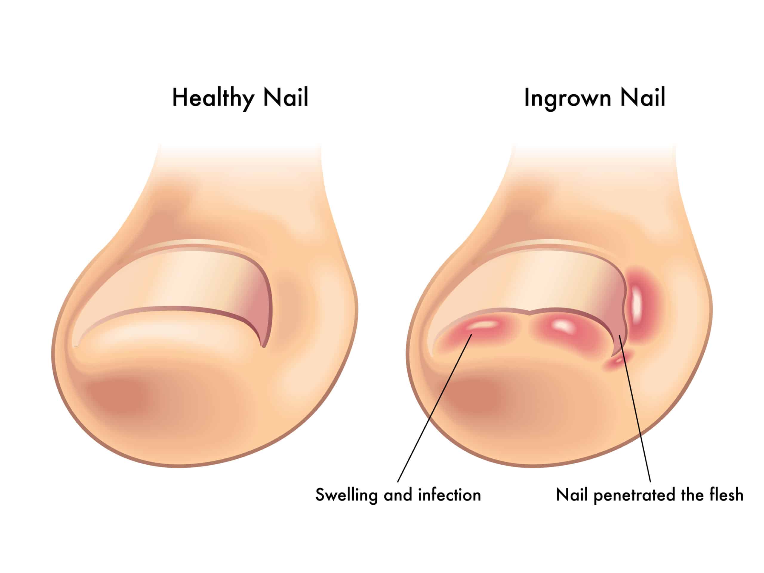 Ingrown Toenail Removal Treatment - Toronto Laser Nail