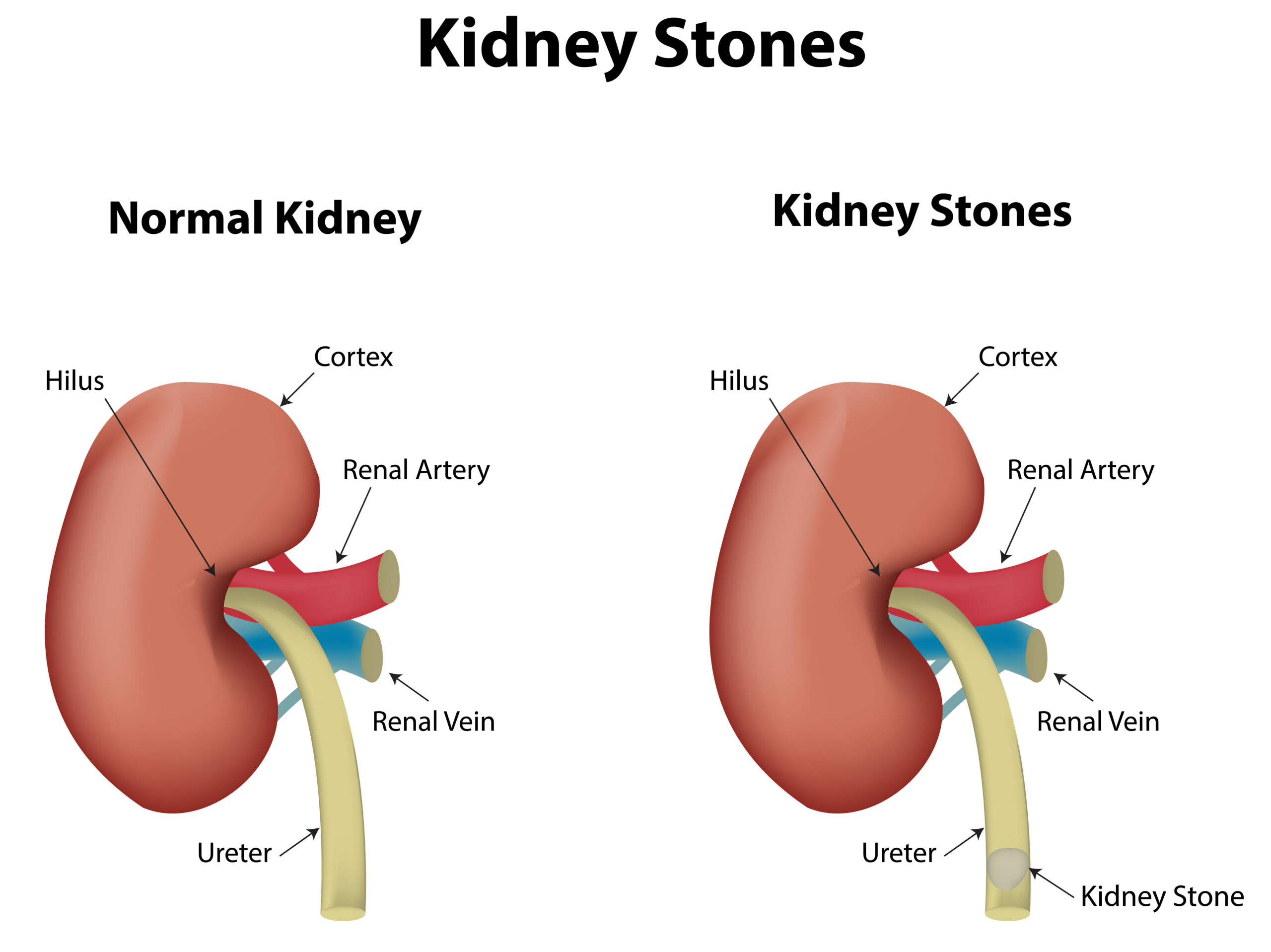 Kidney Stones