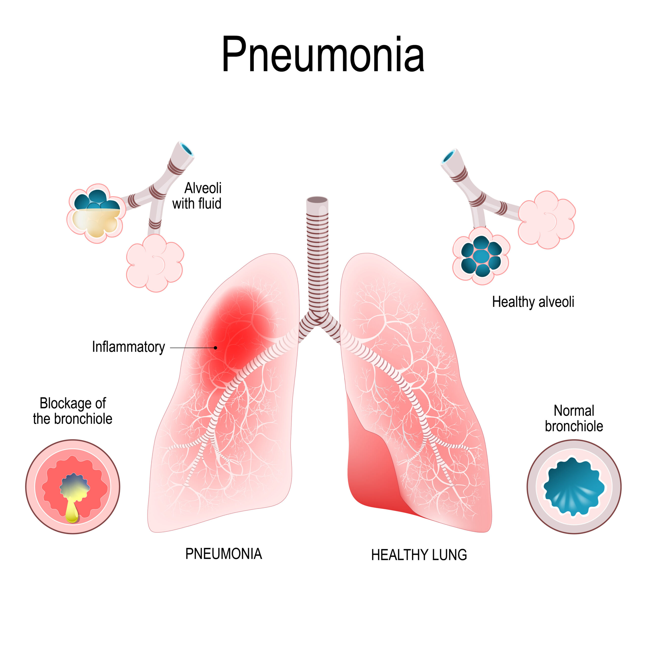 pneumonia