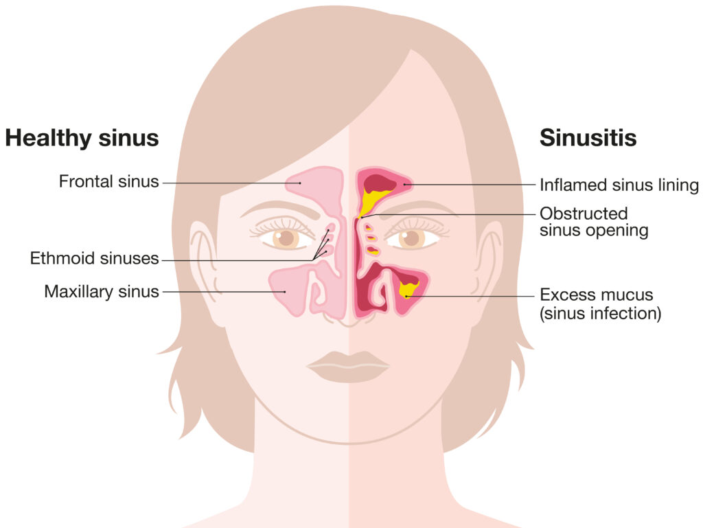 Sinus infection thomasville acute sinusitis lexington