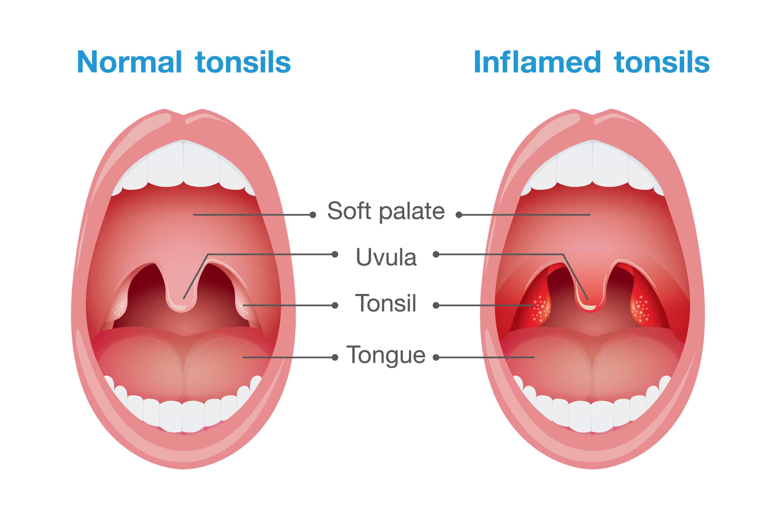 strep throat