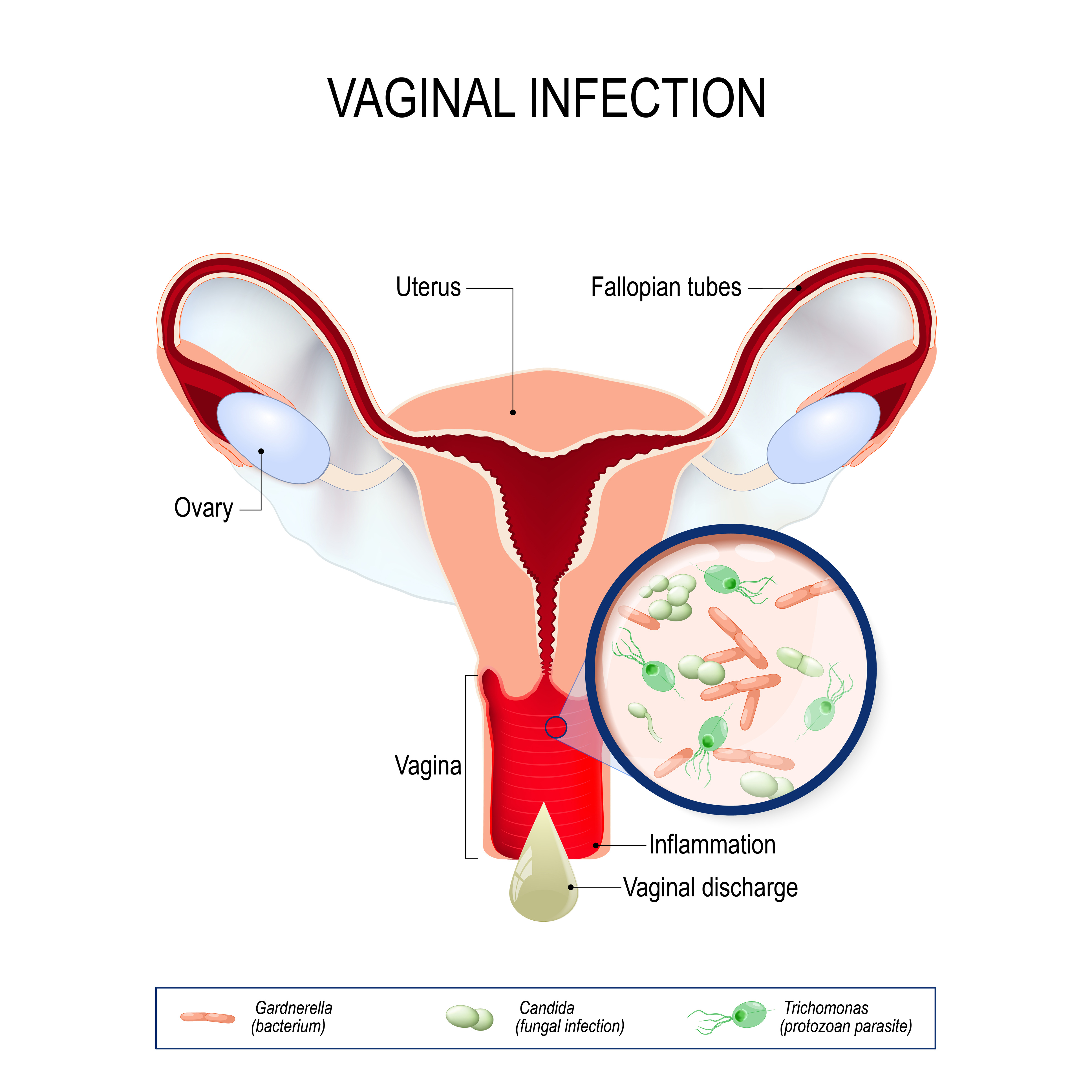 vaginal infection