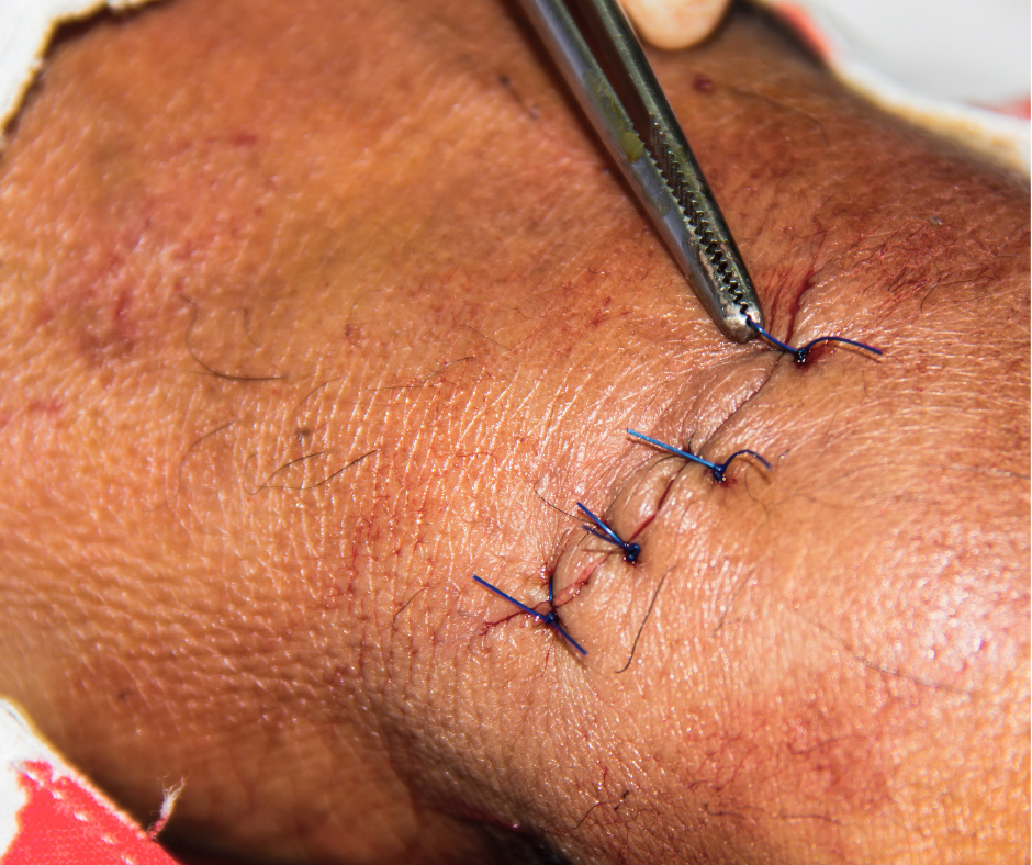 getting stitches